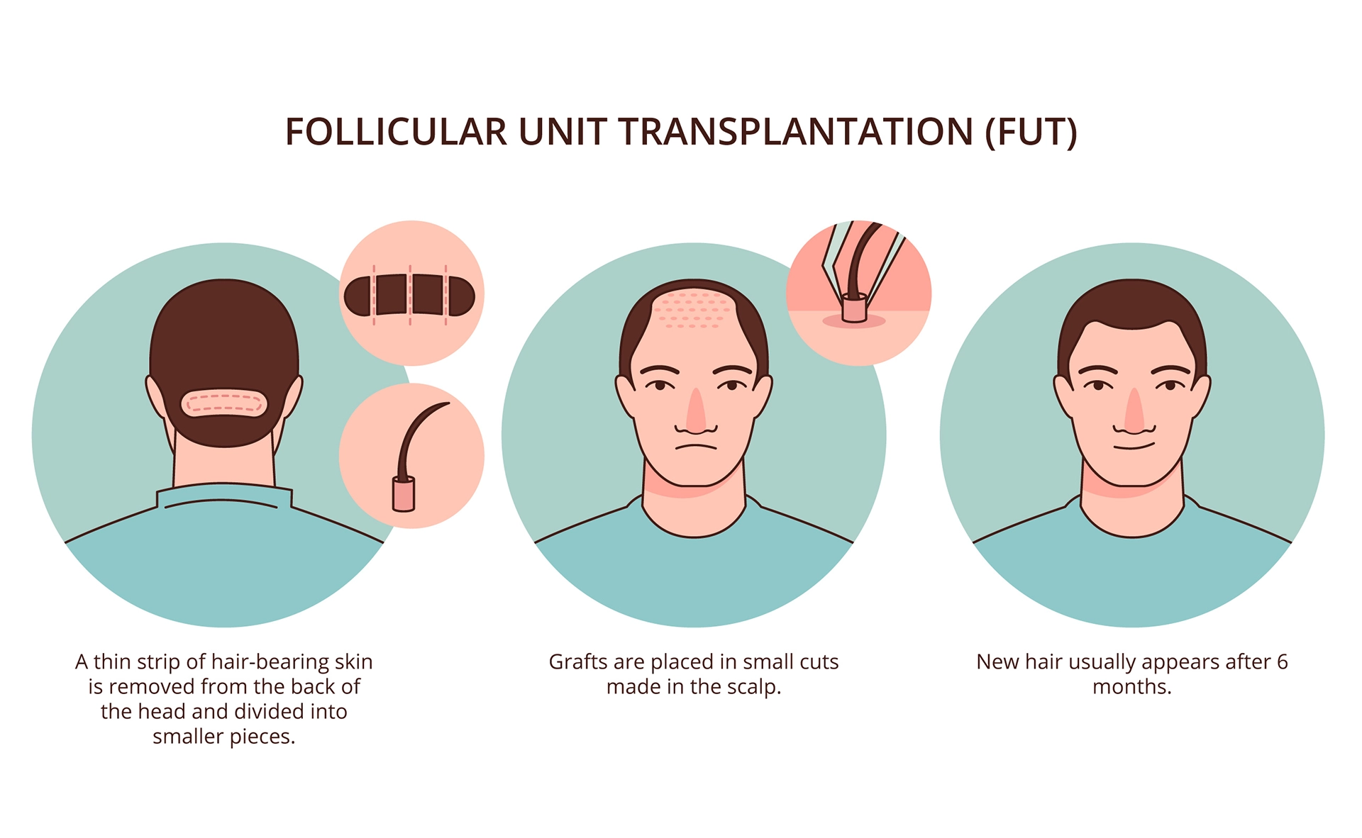 FUT Hair transplantation
