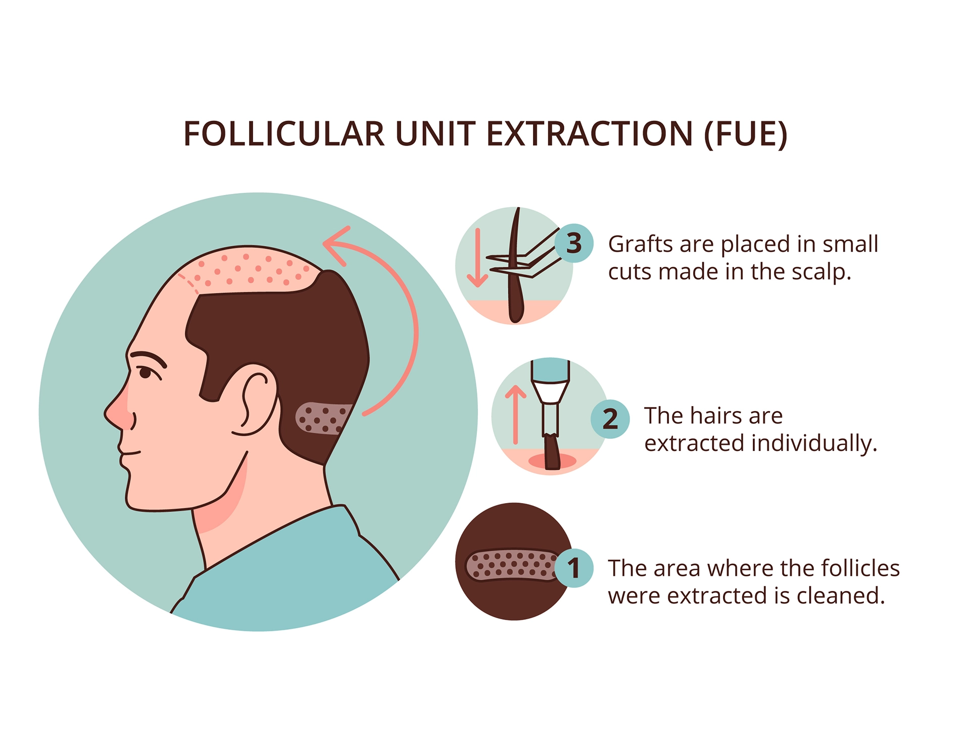 fue hair transplantation